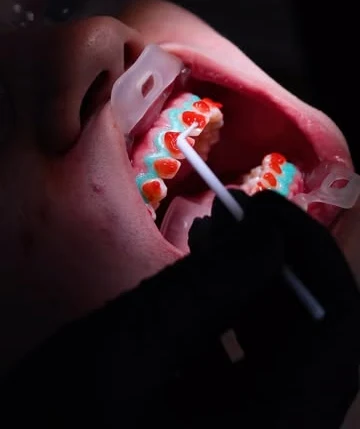 Aplicación de gel de aclaramiento dental profesional con barrera gingival