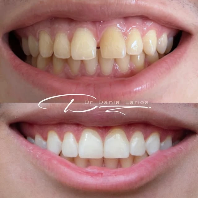 Antes y después de un aclaramiento dental con cierre de diastema en Dentalum