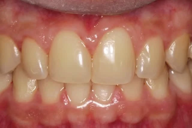 Detalle clínico de dientes tras una limpieza dental profesional